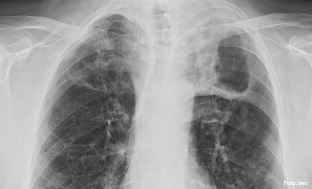 Ilustrační obrázek k výstupu Oznámení o výskytu tuberkulózy je falešné